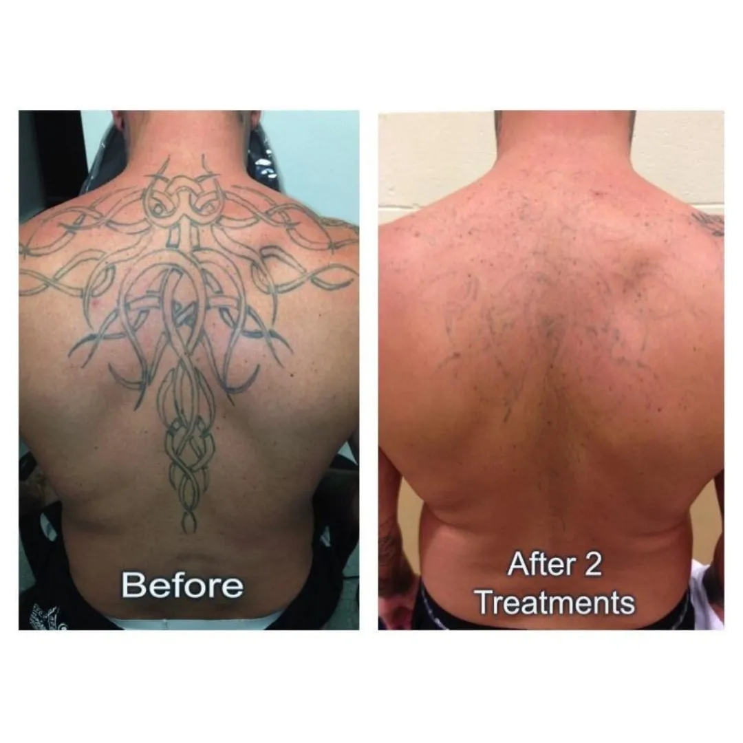 PicoErase Laser Tattoo Removal Machine Professional